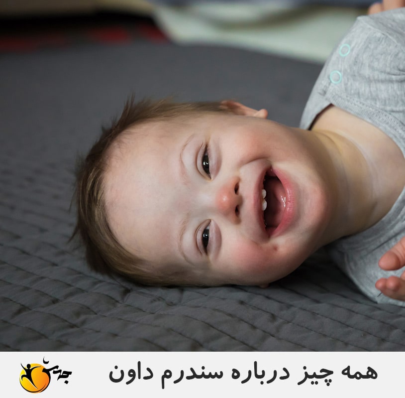 سندرم داون چیست؟