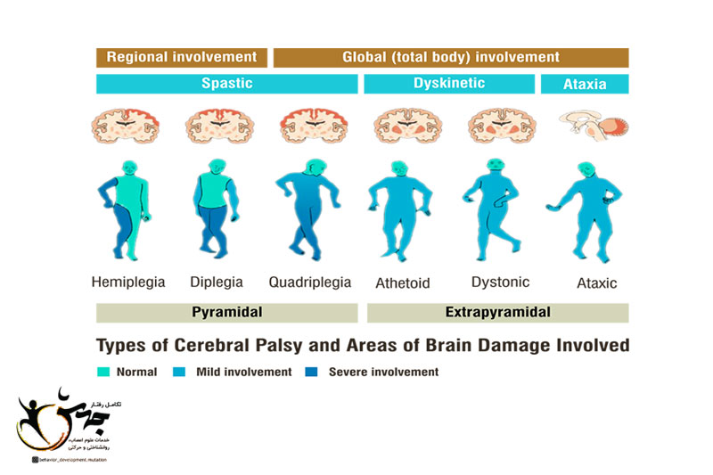 انواع فلج مغزی(cerebral palsy types)