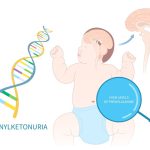 سندرم PKU چیست؟