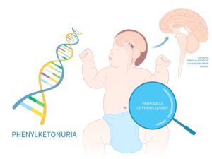 سندرم PKU چیست؟