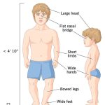 کوتولگی یا Dwarfism