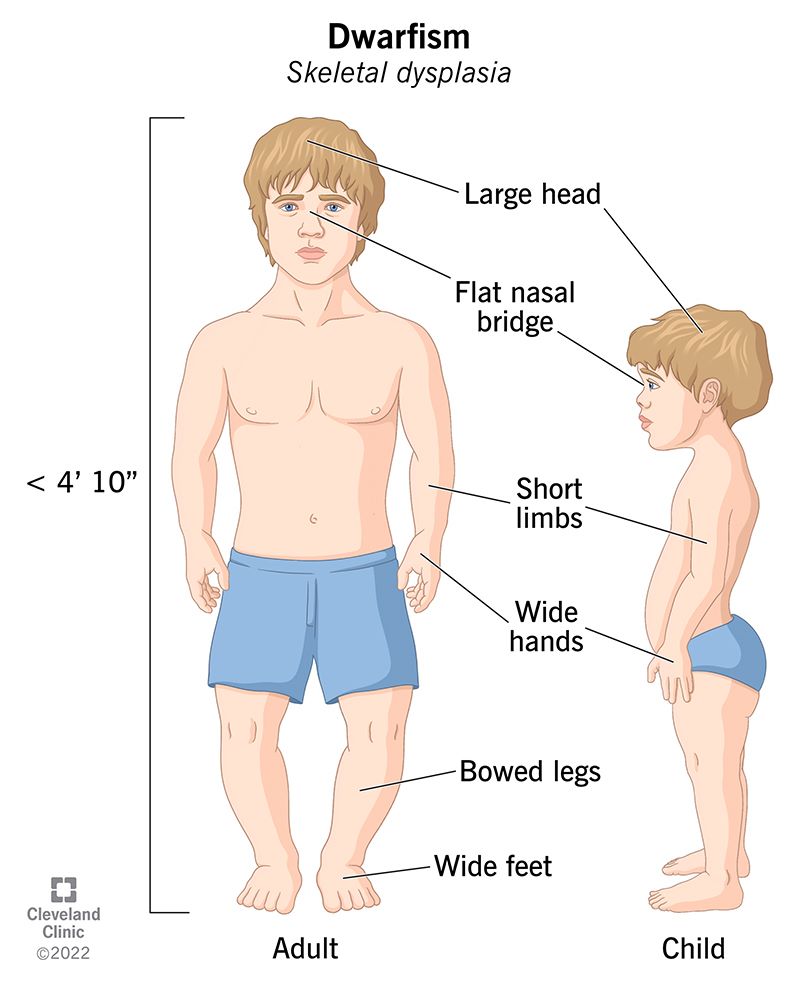کوتولگی یا Dwarfism