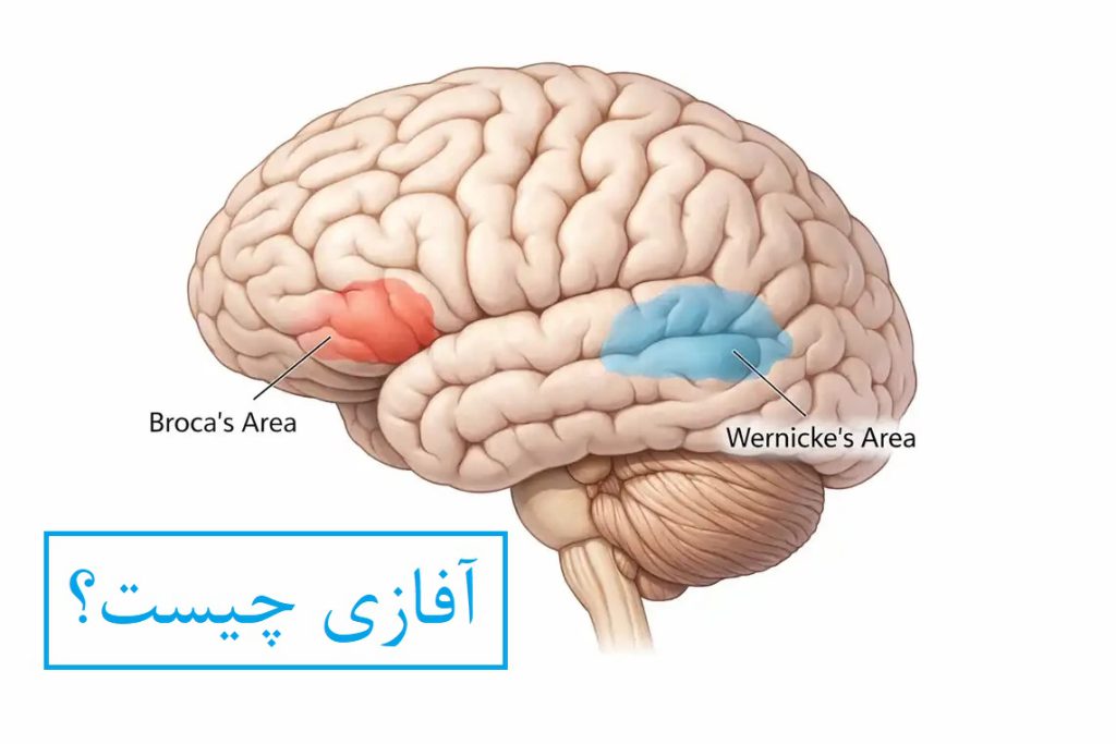 آفازی چیست؟